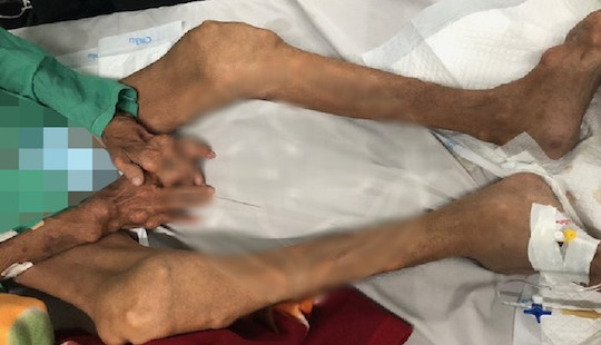 10 năm tự trị bệnh gout, người đàn ông bị biến dạng tay chân