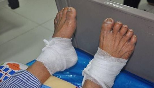 Bỏng độ 3 do đắp hỗn hợp lá ngải cứu trị tiểu đường