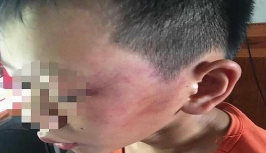 Nghi vấn cô giáo ở Nghệ An đánh con riêng của chồng phải nhập viện