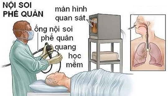 Kết luận nguyên nhân bệnh nhân tử vong khi nội soi phế quản ở BV Bạch Mai