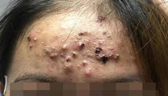 Phát hoảng với gương mặt mưng mủ, đóng vảy của cô gái sau chữa mụn ở phòng khám tư