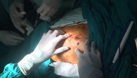 Hai bệnh viện hợp sức cứu sống người đàn ông tự đâm thủng tim