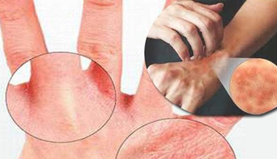 Các bệnh thường gặp sau mùa mưa lũ