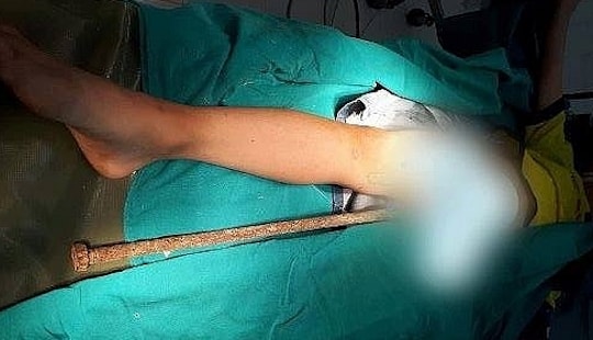 Tai nạn hy hữu, bé trai 6 tuổi bị thanh sắt 60cm đâm xuyên người