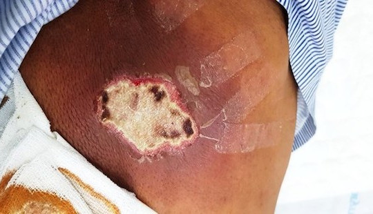 Bất ngờ phát hiện mắc bệnh đái tháo đường sau khi khám vì mọc mụn nhọt ở lưng