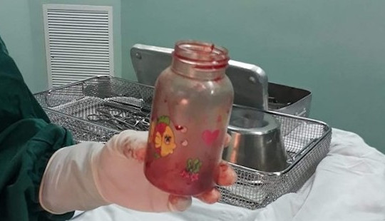 Nhập viện sau khi nhét bình sữa vào hậu môn để chữa thoái hoá cột sống