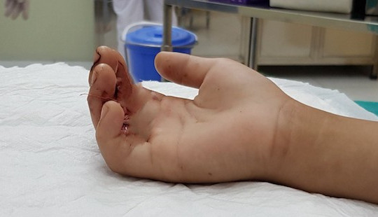 Bé 9 tuổi bị kẹp gần đứt ngón tay khi ngã vào thang máy