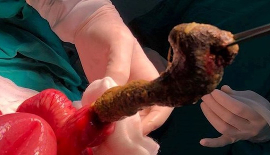 Lấy búi tóc khổng lồ khỏi ruột bé gái “thèm ăn tóc"