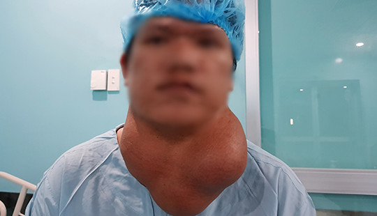 Cắt bỏ thành công khối u “khổng lồ” cho nam bệnh nhân