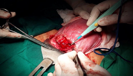 Đẻ con tại nhà, sản phụ 34 tuổi vỡ tử cung nguy kịch
