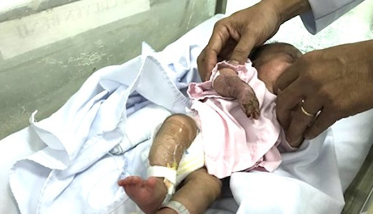 Cứu sống ngoạn mục bé sinh non bị viêm màng não, hoại tử lộ xương