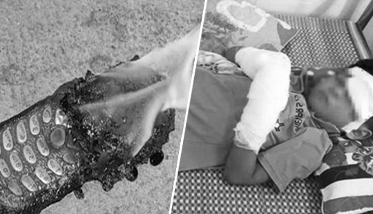 Điện thoại đang sạc pin phát nổ, cháu bé 7 tuổi bị dập nát tay