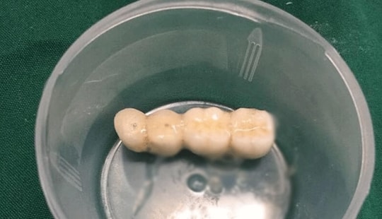Đi làm răng, cụ ông 90 tuổi bị 4 răng giả rơi vào phế quản