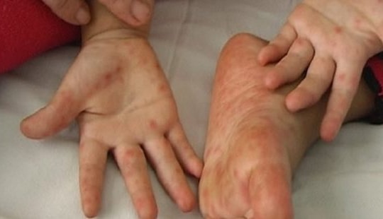 Bé 2 tuổi ở Bến Tre tử vong do bệnh tay chân miệng