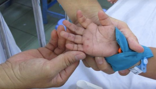 Quảng Ngãi: Gia tăng bệnh tay chân miệng, hơn 900 ca mắc