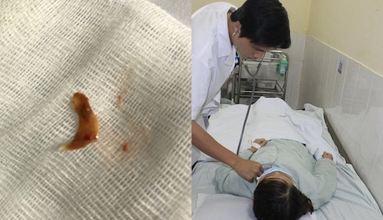 Mảnh xương vịt “cư trú” suốt 3 tháng trong phế quản người phụ nữ