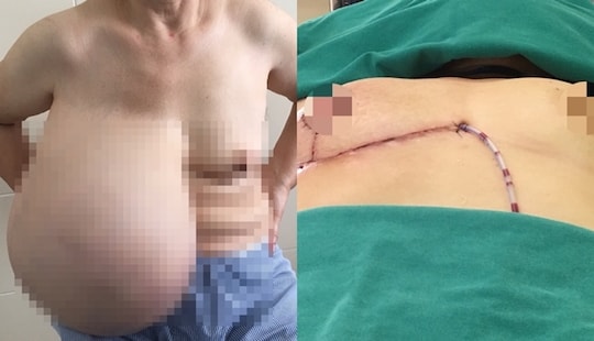 Lệch cột sống vì “đeo” khối u vú gần 9kg hàng chục năm