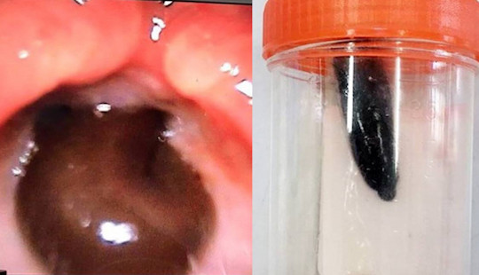 Con đỉa dài 5cm sống trong cổ họng bé gái suốt 2 tháng