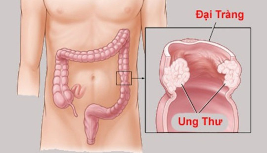 Ung thư đại trực tràng: Phát hiện sớm, dễ điều trị