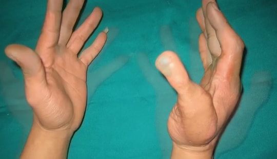 Mất ngón tay, ghép ngón chân thay thế