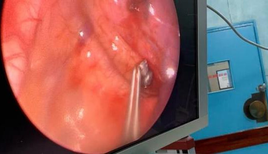 Bé 6 tuổi suýt mất mạng vì đạn bắn xuyên từ cổ xuống ngực