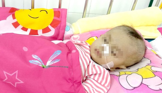 Tiên lượng 90% tử vong, bé 8 tháng tuổi bị hẹp khí quản được cứu sống ngoạn mục