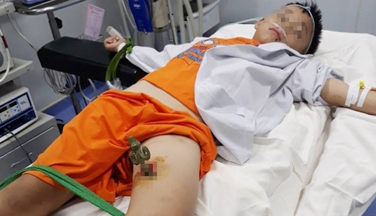 Ngã cành cây, bé 9 tuổi bị thanh sắt đâm xuyên đùi
