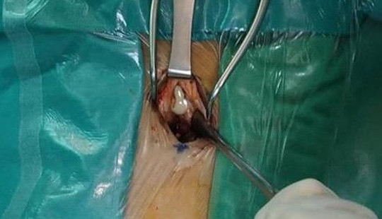 Từ 1 vết phỏng nước, bé 9 tuổi mắc bệnh truyền nhiễm hiếm gặp