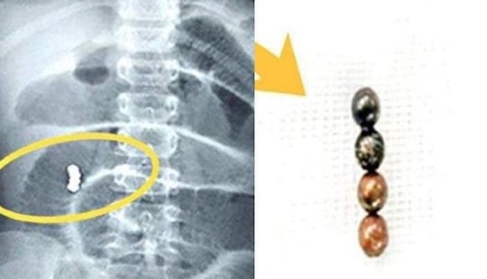 Nuốt 4 viên bi nam châm, bé 6 tuổi bị thủng ruột