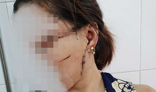 Cắt gân chân, rạch mặt vợ vì ghen tuông