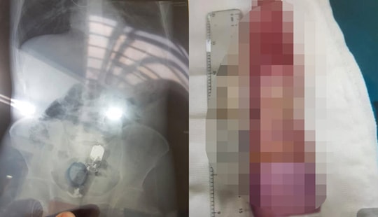 Dương vật giả kẹt sâu trong hậu môn, nam thanh niên nguy kịch