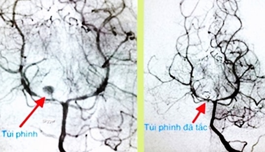 Cứu sống bé gái 3 tuổi bị vỡ túi phình mạch máu não hiếm gặp