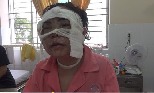 Cô gái sắp lấy chồng bị tạt axit làm hỏng đôi mắt
