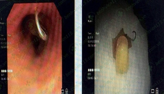 Sau cơn ho, người đàn ông bị răng giả “chui tọt” vào phế quản