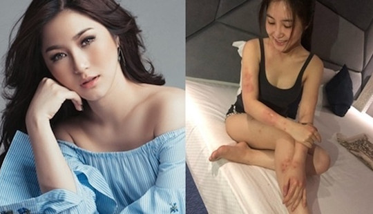 Hương Tràm nổi mẩn đỏ khắp người vì dị ứng cấp tính: Bệnh có nguy hiểm không?