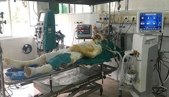 Cụ ông tử vong vì sốc nặng sau khi chữa bỏng ở nhà thầy lang