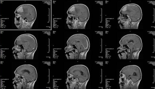 Phát hiện u não khổng lồ sau 1 tháng đau đầu, mờ mắt