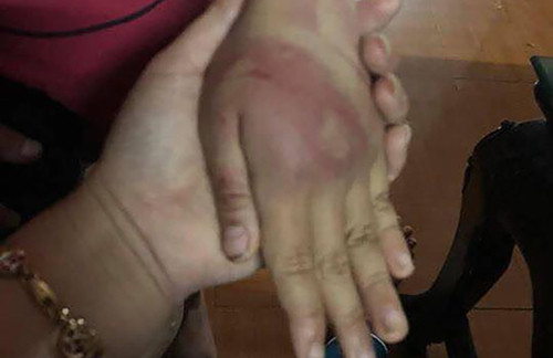 Bé gái 8 tuổi bị bố đẻ đánh bầm dập khắp cơ thể