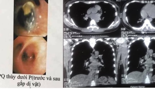 Ho dai dẳng 10 năm vì hạt hồng xiêm “bỏ quên” trong phế quản
