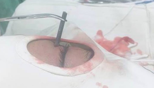 Sửa nhà đón Tết, người đàn ông suýt mù do đinh bắn vào mắt