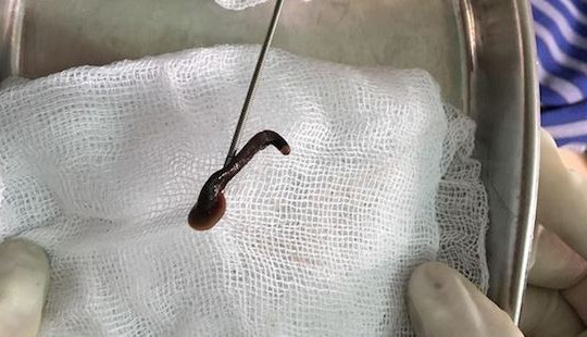 Bị ho kéo dài, người đàn ông tá hỏa phát hiện đỉa sống trong cổ họng