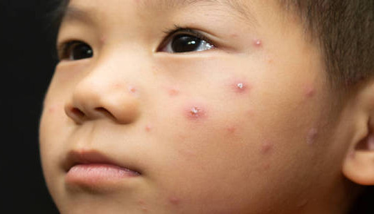 Nhiều trẻ mắc sởi từ trào lưu “anti vắc xin”: Người lớn a dua, trẻ con chịu trận