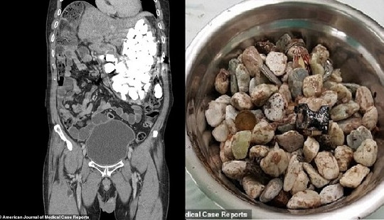 Giật mình với 2kg đá sỏi, đồng xu trong dạ dày người đàn ông