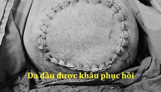 Tóc cuốn vào máy xay tiêu, bé gái bị lóc da đầu nghiêm trọng