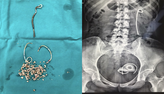 “Bỏ quên” stent 5 năm trong niệu quản, cô gái Hà Nội gặp biến chứng nguy hiểm