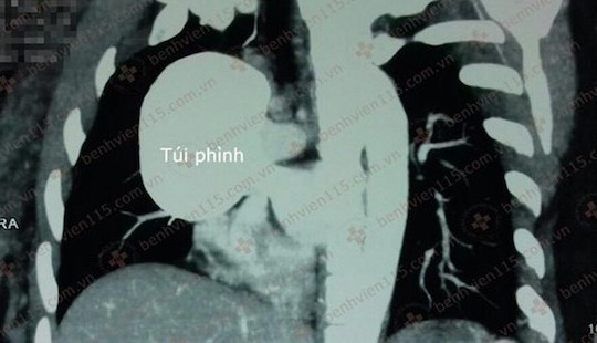 Người phụ nữ suýt mất mạng sau 2 tuần đau ngực, khó thở