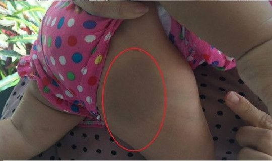 Bé 8 tháng tuổi bị đánh bầm tím người trong phòng trọ khóa trái