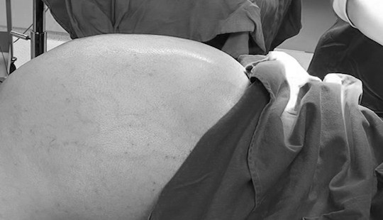 Giải cứu nam thanh niên khỏi khối u khổng lồ nặng 25kg