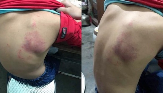 Cô giáo ở Hải Phòng bị tố đánh tím lưng học sinh lớp 2