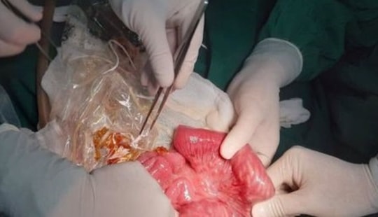 Bé trai 3 tuổi tắc ruột vì búi giun lớn chiếm hết ổ bụng